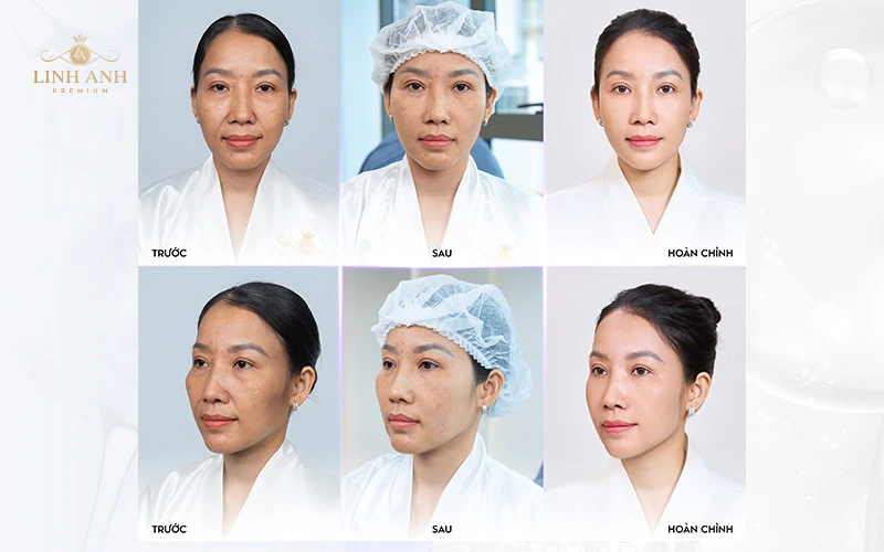 “GIẢI MÔ CÔNG NGHỆ TRẺ HÓA YOUTHLIFT: KHOA HỌC BẮT ĐẦU TỪ MÁY VISIA 8.0